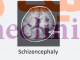 اسکیزانسفالی‏ یا شیزنسفالی (Schizencephaly) چیست؟
