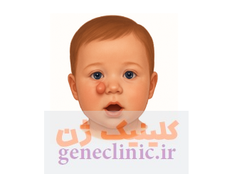 داکریوسیستوسل‏ (Dacryocystocele) چیست؟