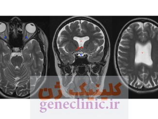 ‏دیسپلازی سپتو-اپتیک‏ (Septo-optic dysplasia) چیست؟