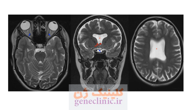 ‏دیسپلازی سپتو-اپتیک‏ (Septo-optic dysplasia) چیست؟