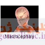 ‏‏ماکروسفالی‏ (Macrocephaly) چیست؟