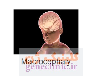 ‏‏ماکروسفالی‏ (Macrocephaly) چیست؟