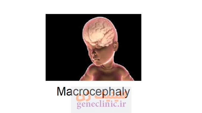 ماکروسفالی (Macrocephaly) چیست؟ ماکروسفالی (Macrocephaly) چیست؟