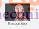 ‏‏ماکروسفالی‏ (Macrocephaly) چیست؟