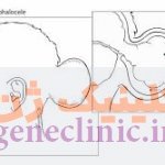 انسفالوسل ، Encephalocele