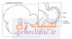 انسفالوسل ، Encephalocele
