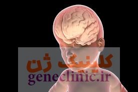 ماکروسفالی‏، Macrocephaly