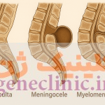 ‏اسپینا بیفیدا (Spina bifida) چیست؟