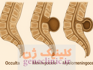 ‏اسپینا بیفیدا (Spina bifida) چیست؟