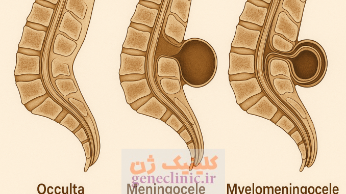 ‏اسپینا بیفیدا (Spina bifida) چیست؟