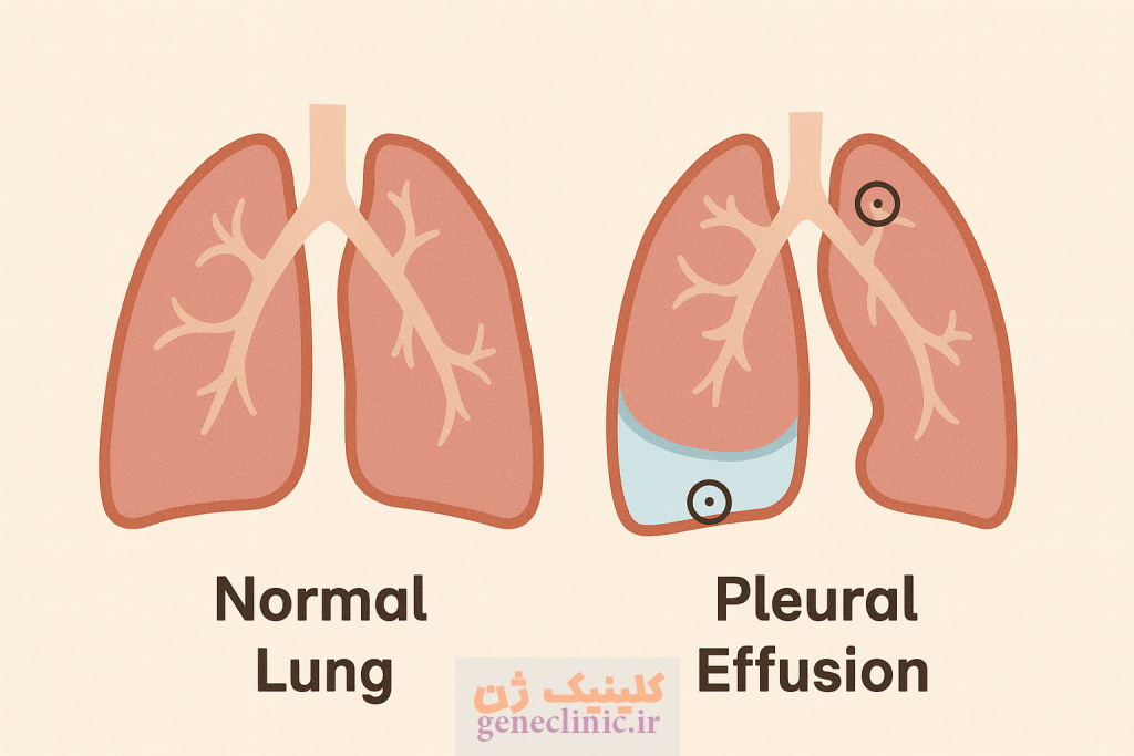 ‏پلورال افیوژن‏ (Pleural effusion) چیست؟