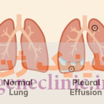‏پلورال افیوژن‏ (Pleural effusion) چیست؟