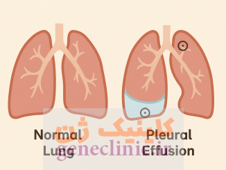 ‏پلورال افیوژن‏ (Pleural effusion) چیست؟