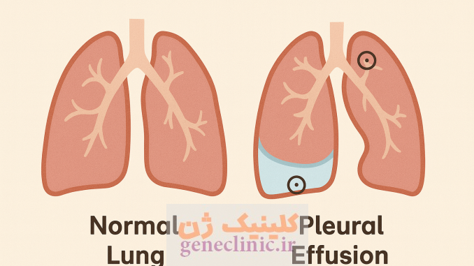 ‏پلورال افیوژن‏ (Pleural effusion) چیست؟