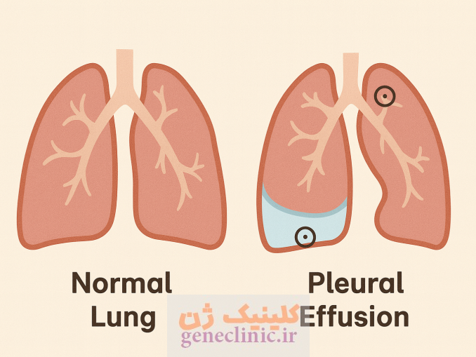 ‏پلورال افیوژن‏ (Pleural effusion) چیست؟