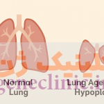 ‏آژنزی یا هیپوپلازی ریه‏ (Lung agenesis-hypoplasia) چیست؟