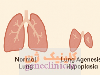 ‏آژنزی یا هیپوپلازی ریه‏ (Lung agenesis-hypoplasia) چیست؟