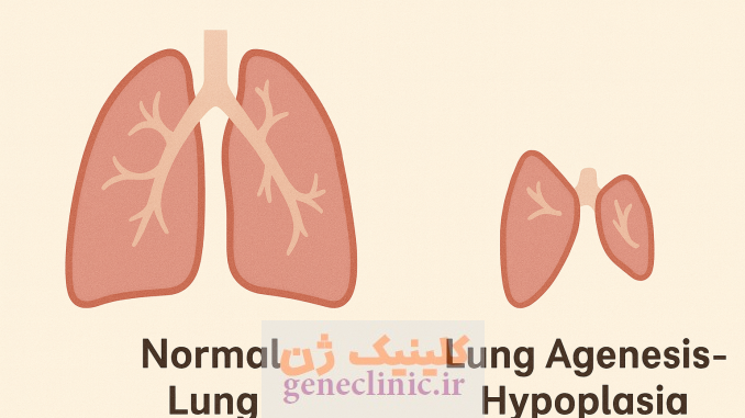 ‏آژنزی یا هیپوپلازی ریه‏ (Lung agenesis-hypoplasia) چیست؟