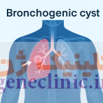 ‏کیست برونکوژنیک‏ (Bronchogenic cyst) چیست؟