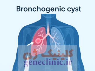 ‏کیست برونکوژنیک‏ (Bronchogenic cyst) چیست؟