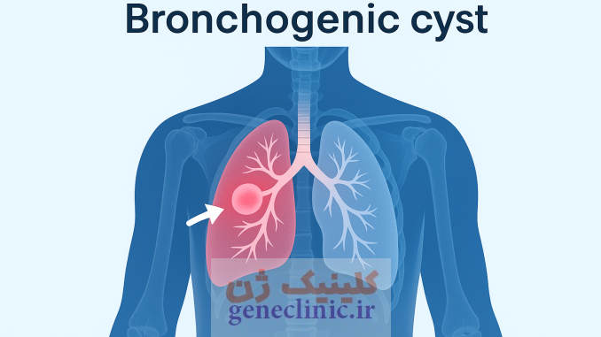 ‏کیست برونکوژنیک‏ (Bronchogenic cyst) چیست؟