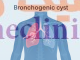 ‏کیست برونکوژنیک‏ (Bronchogenic cyst) چیست؟