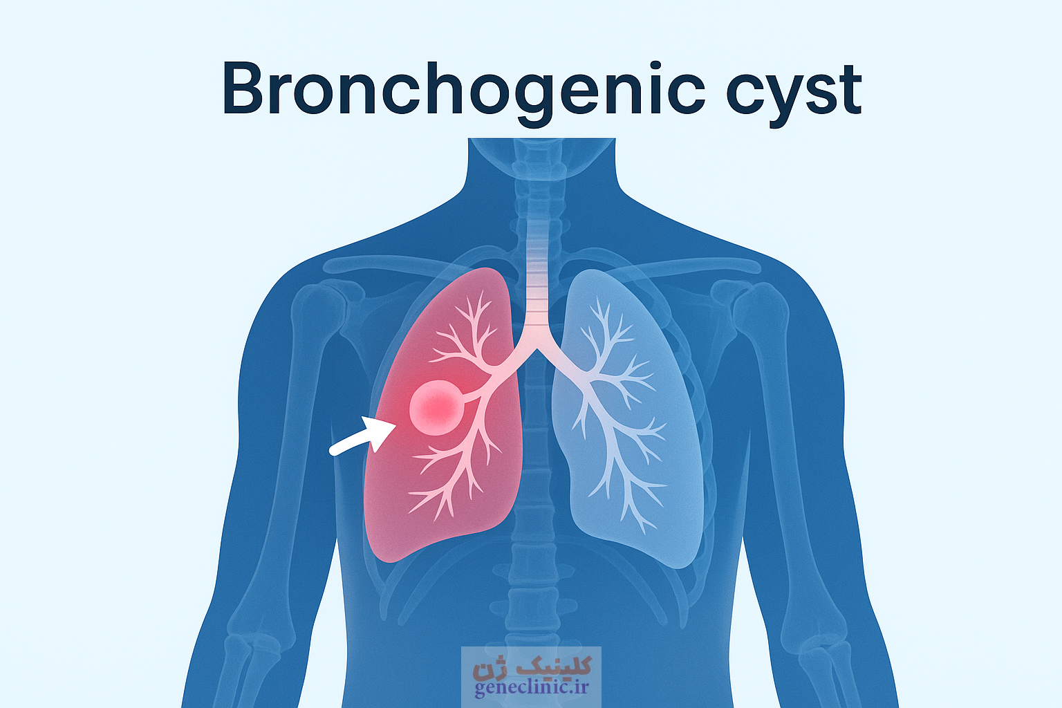 ‏کیست برونکوژنیک‏ (Bronchogenic cyst) چیست؟