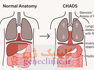 ‏سندرم انسداد مادرزادی راه هوایی فوقانی (Congenital high airway obstruction syndrome) چیست؟