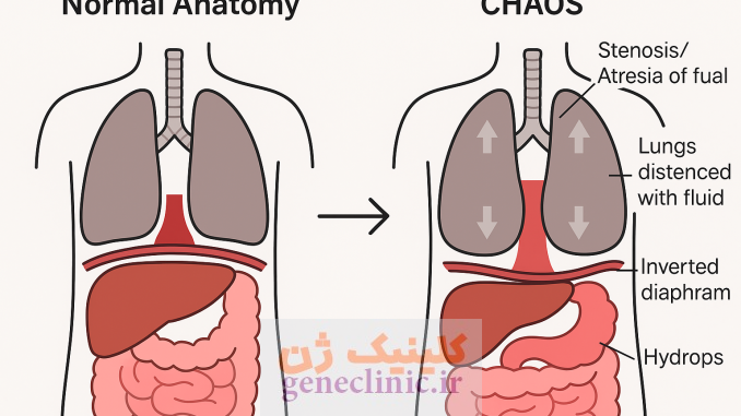 ‏سندرم انسداد مادرزادی راه هوایی فوقانی (Congenital high airway obstruction syndrome) چیست؟