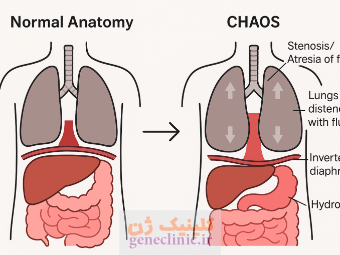 ‏سندرم انسداد مادرزادی راه هوایی فوقانی (Congenital high airway obstruction syndrome) چیست؟