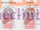‏سندرم انسداد مادرزادی راه هوایی فوقانی (Congenital high airway obstruction syndrome) چیست؟