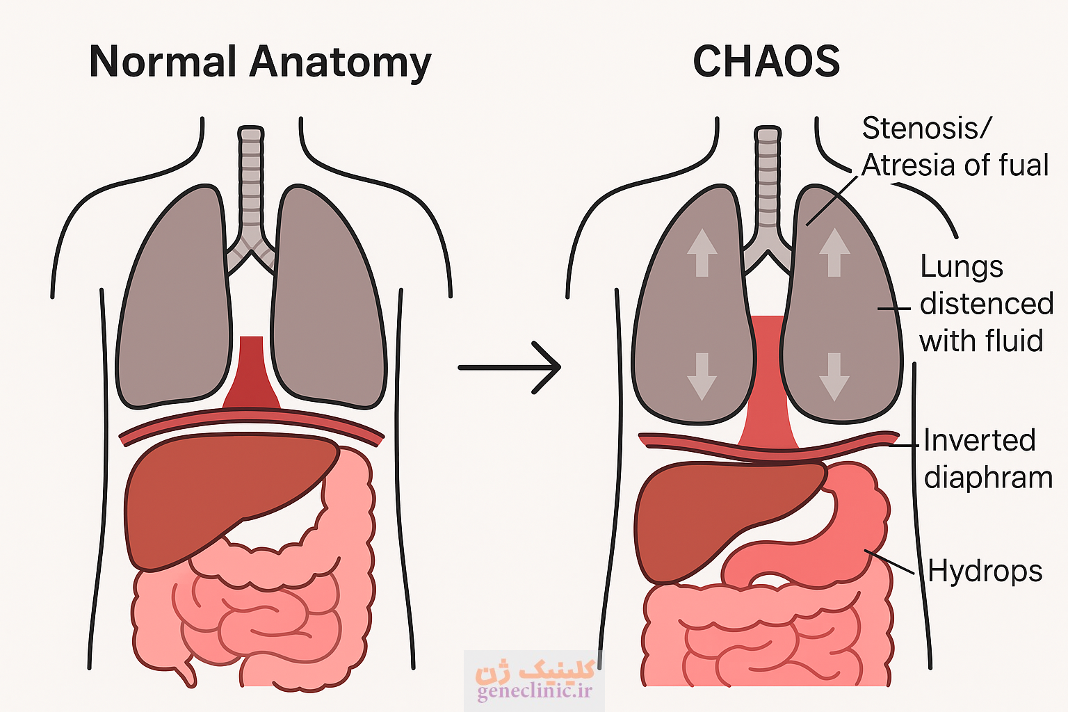 ‏سندرم انسداد مادرزادی راه هوایی فوقانی (Congenital high airway obstruction syndrome) چیست؟