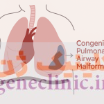ناهنجاری مادرزادی راه هوایی (Congenital pulmonary airway malformation) یا CPAM چیست؟