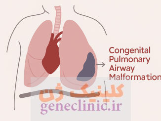 ناهنجاری مادرزادی راه هوایی (Congenital pulmonary airway malformation) یا CPAM چیست؟