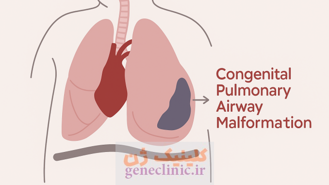 ناهنجاری مادرزادی راه هوایی (Congenital pulmonary airway malformation) یا CPAM چیست؟ ناهنجاری مادرزادی راه هوایی (Congenital pulmonary airway malformation) یا CPAM چیست؟