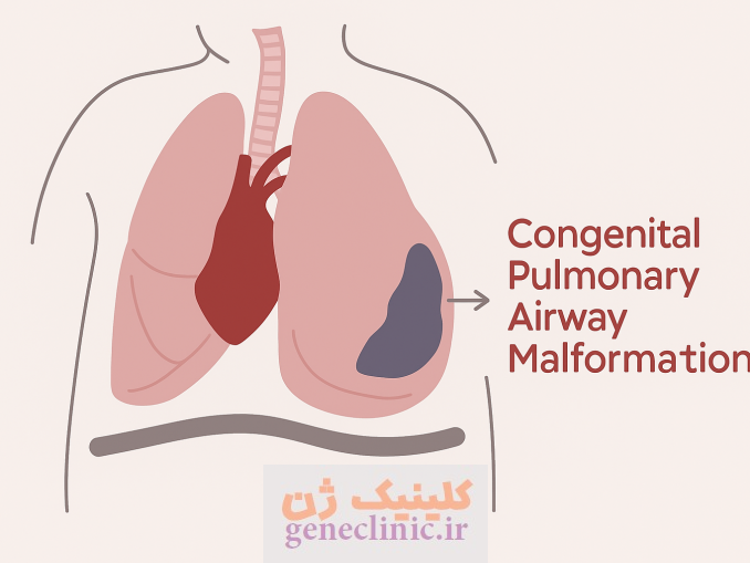 ناهنجاری مادرزادی راه هوایی (Congenital pulmonary airway malformation) یا CPAM چیست؟