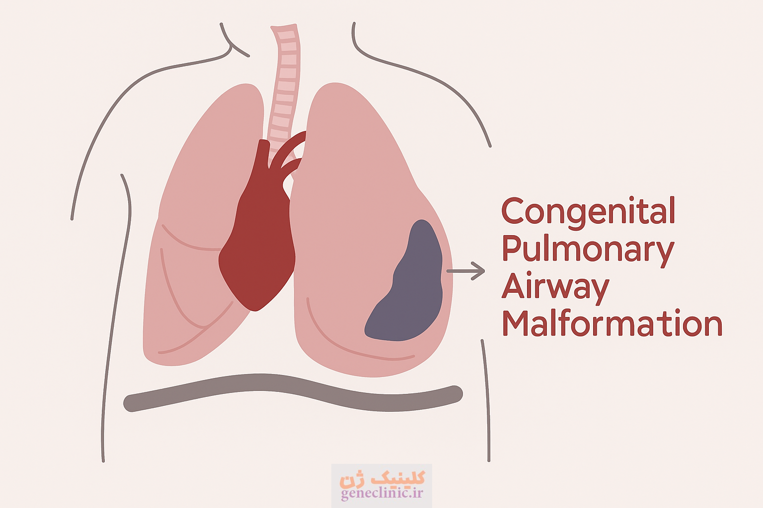 ناهنجاری مادرزادی راه هوایی (Congenital pulmonary airway malformation) یا CPAM چیست؟