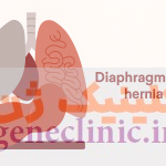 ‏فتق دیافراگم‏ یا هرنی دیافراگم (Diaphragmatic hernia) چیست؟