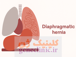‏فتق دیافراگم‏ یا هرنی دیافراگم (Diaphragmatic hernia) چیست؟