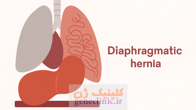 فتق دیافراگم یا هرنی دیافراگم (Diaphragmatic hernia) چیست؟ فتق دیافراگم یا هرنی دیافراگم (Diaphragmatic hernia) چیست؟