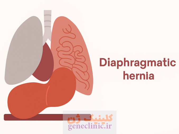 ‏فتق دیافراگم‏ یا هرنی دیافراگم (Diaphragmatic hernia) چیست؟