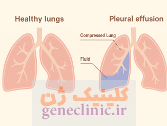 ‏پلورال افیوژن‏ (Pleural effusion) چیست؟