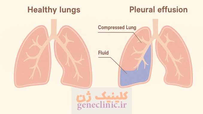 پلورال افیوژن (Pleural effusion) چیست؟ پلورال افیوژن (Pleural effusion) چیست؟