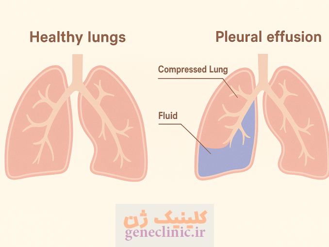 ‏پلورال افیوژن‏ (Pleural effusion) چیست؟