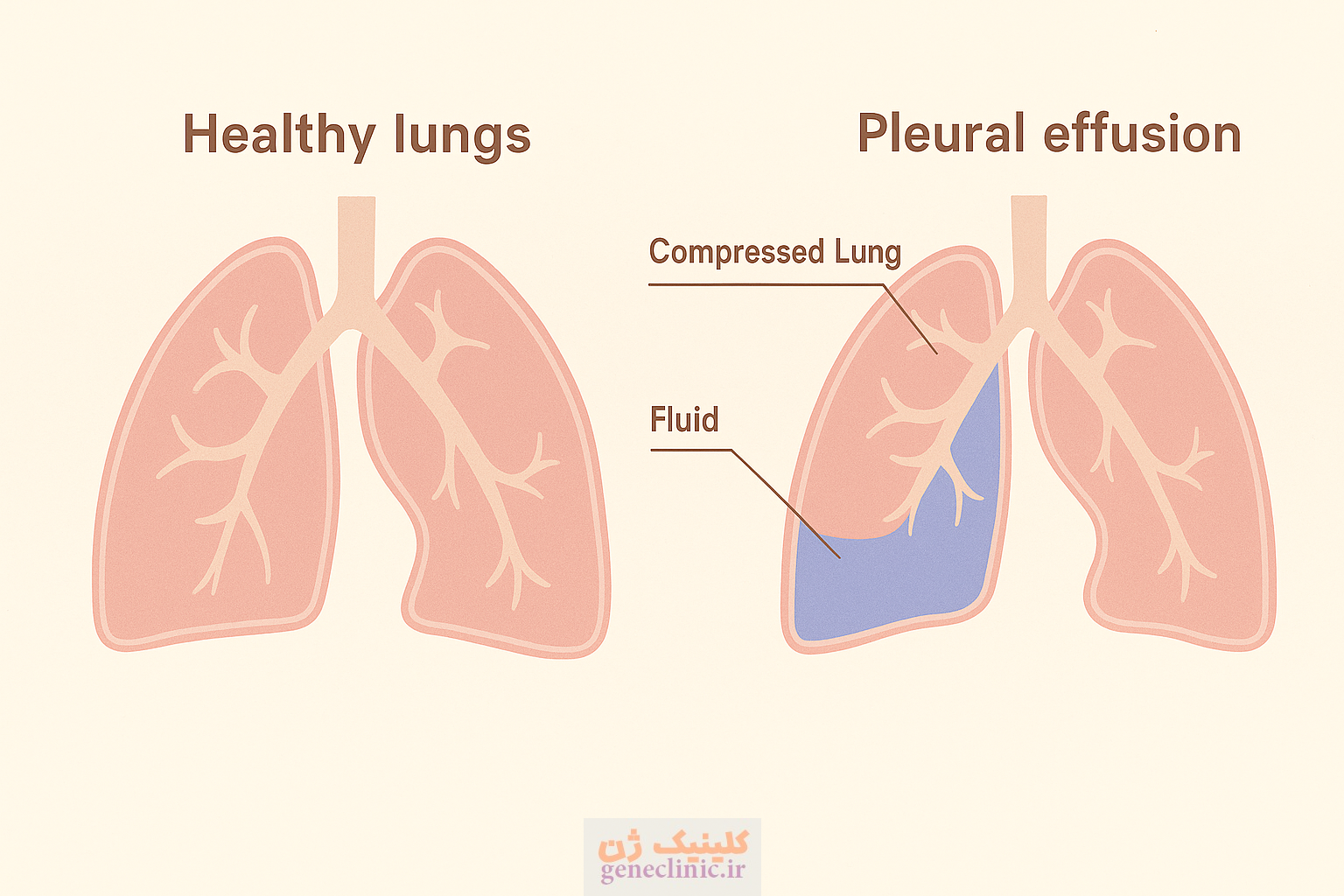 ‏پلورال افیوژن‏ (Pleural effusion) چیست؟