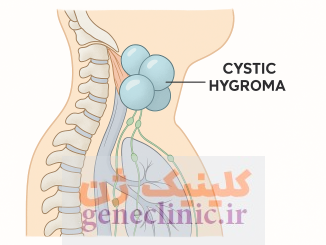 سیستیک هیگروما یا هیگرومای کیستیک (Cystic hygroma) چیست؟