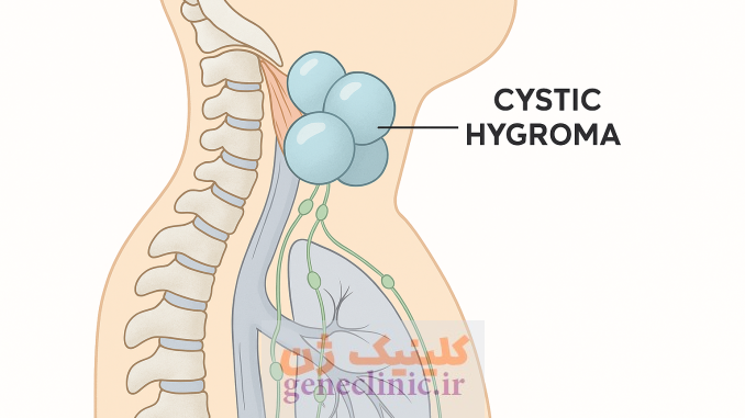 سیستیک هیگروما یا هیگرومای کیستیک (Cystic hygroma) چیست؟