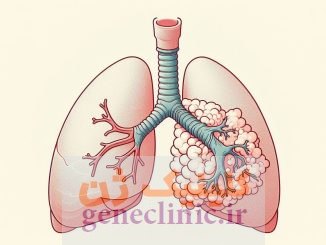 آترزی برونش‏ (Bronchial atresia) چیست؟