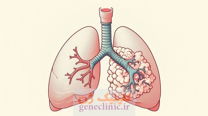 آترزی برونش‏ (Bronchial atresia) چیست؟