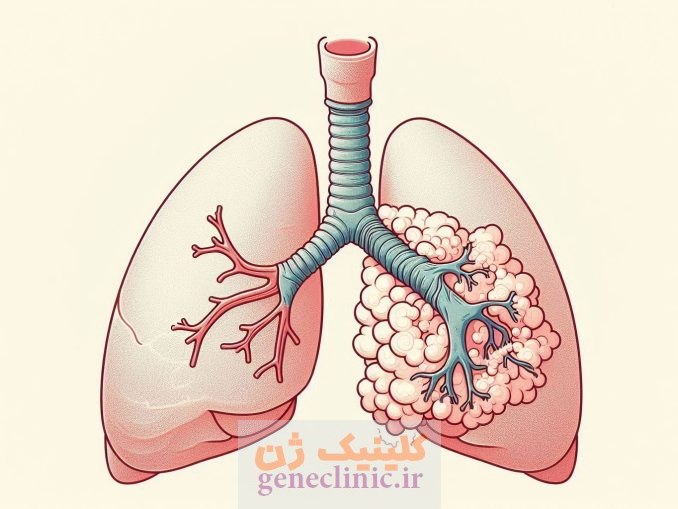 آترزی برونش‏ (Bronchial atresia) چیست؟